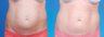 Mini Tummy Tuck with Diastasis Repair
