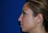 Rhinoplasty