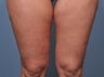 35 Year Old Female Treated For Abdominal and Thigh Skin Excess