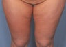 35 Year Old Female Treated For Abdominal and Thigh Skin Excess