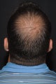 Hair Restoration