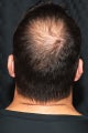 Hair Restoration