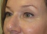 46 year old with eyelid bags undergoing filler treatment