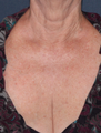Fraxel Repair on Chest
