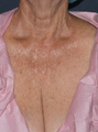 Fraxel Repair on Chest