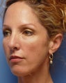 Cheek Dermafillers, Eye Dermafillers, Facial Dermafillers