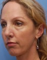 Cheek Dermafillers, Eye Dermafillers, Facial Dermafillers