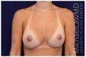 Breast Augmentation