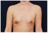 Breast Augmentation