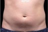 Liposonix