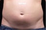 Liposonix