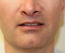 Lip Lift (permanent lip enhancement)