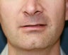 Lip Lift (permanent lip enhancement)