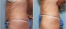 56 year old female with abdominal laxity