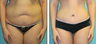 Liposuction Before & After