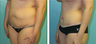 Liposuction Before & After