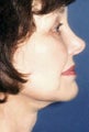 face/neck lift