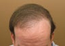 Hair transplant FUE Neograft from chest to head