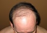 Hair transplant FUE Neograft from chest to head