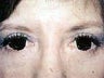 Eyelid Surgery