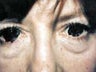 Eyelid Surgery