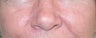 53 year old Female with Facial Veins / Telangiectasia