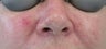 53 year old Female with Facial Veins / Telangiectasia