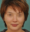 Asian rhinoplasty and genioplasty
