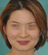 Asian rhinoplasty and genioplasty