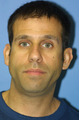 Otoplasty