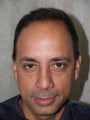 Hair Transplant - 3400 grafts