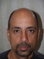 Hair Transplant - 3400 grafts