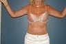 Arm lift or brachioplasty with short scar in the armpit.
