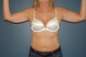 Arm lift or brachioplasty with short scar in the armpit.