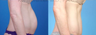 Mini Tummy Tuck