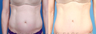 Mini Tummy Tuck