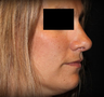 Rhinoplasty