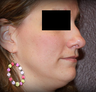 Rhinoplasty