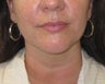Chin liposuction/Liposculpture