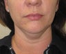 Chin liposuction/Liposculpture