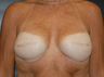 Breast Reconstruction