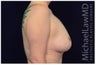 Breast Lift - Mastopexy