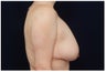 Breast Lift - Mastopexy
