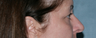 Fraxel Repair Around the Eyes