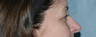 Fraxel Repair Around the Eyes