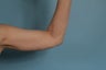 Amr Lift (Brachioplasty)