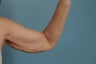 Amr Lift (Brachioplasty)