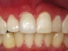 Porcelain Crown to Fix a Broken Tooth Before & After Photo