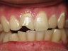 Porcelain Crown to Fix a Broken Tooth Before & After Photo