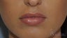 21 y/o female desired fuller lips (especially her upper lip) with filler.